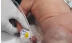 تومور بزرگ با انجام عمل نادر از بدن نوزاد ۴ روزه خارج شد