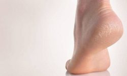چگونه “ترکِ کف پا” را از بین ببریم؟