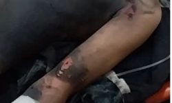 ترقه دو دست نوجوان روانسری را قطع کرد