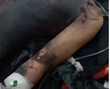 ترقه دو دست نوجوان روانسری را قطع کرد