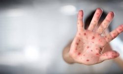 آبلهمرغان» چگونه درمان میشود؟