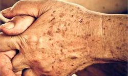 ارتباط افزایش لکه سنی با سن افراد
