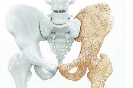 از پوکی استخوان چه میدانید