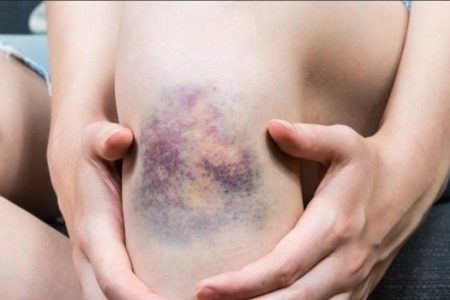 ورود اولین داروی نوظهور پیشگیری «همیلبرا»، نجات‌بخش برای بیماران هموفیلی