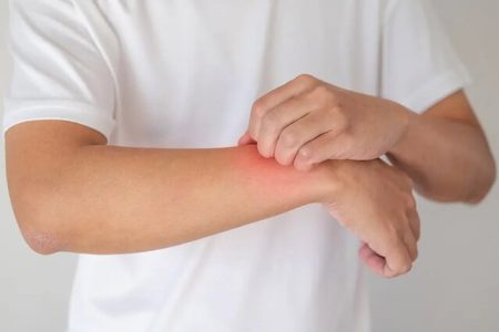 نور خورشید و تماس با برخی گیاهان، عامل بروز حسیاست پوستی افراد در فصل بهار