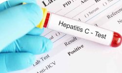 کرمانشاه پایلوت حذف هپاتیت C شد