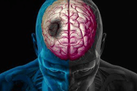 نجات جان ۳۴ بیمار سکته مغزی در کرمانشاه